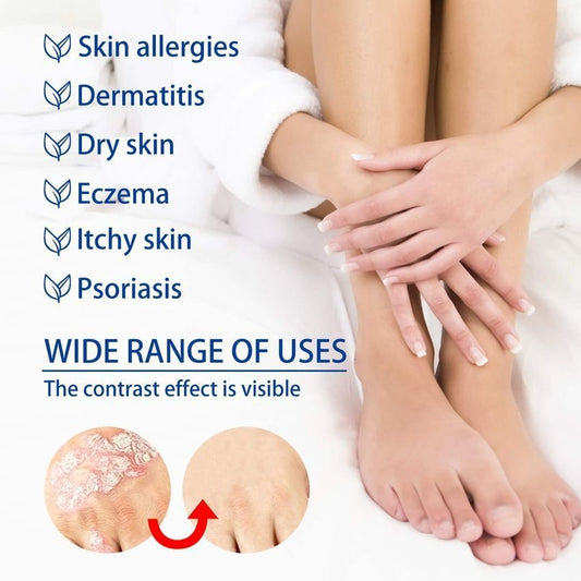 Antibacterial Psoriasis Ointment Cream